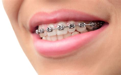 what are the most affordable braces